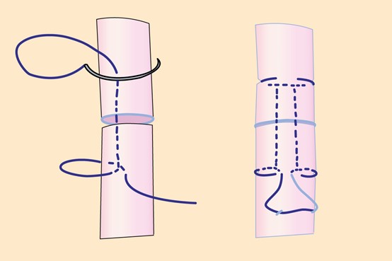 Common Suture Patterns